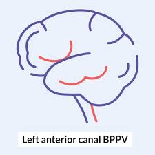 One can certainly opt to just wait it out. Benign Paroxysmal Positional Vertigo Amboss