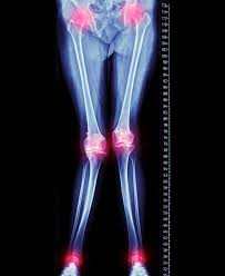 Zur unteren extremität gehört außerdem noch der beckengürtel . X Bein Und O Bein Fehlstellungen Im Knie Entgegenwirken Gelenk Klinik De