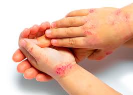 Image result for dermatitis contacta