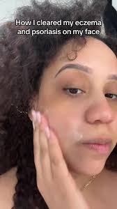 I dont know whats in this but it worked like MAGIC #theoceanhealedmyeczema  #eczema #psoriasis #seamosseczemacream