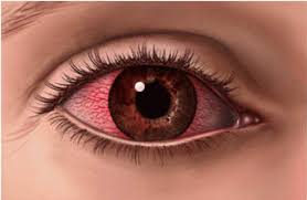 Prevencion De La Conjuntivitis Farmacia Seccion Optica Vazquez