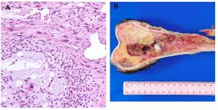 Image result for Chondrosarcoma