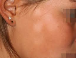 Pityriasis alba on the cheek. Bilder Von Pityriasis Alba Dermatly Com Die Website Ihrer Haut