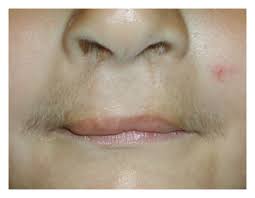 Those tiny hairs on the upper lip make them even more visible when we apply lipstick. Upper Lip Of The Patient At Age 3 6 12 Yrs Note The Moustache With Download Scientific Diagram