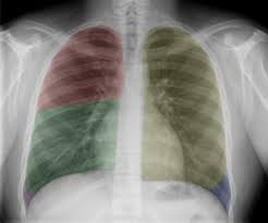 You have completed this module. Normal Chest X Ray Lobes Illustration Radiology Case Radiopaedia Org