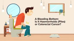 Signs and symptom of colon cancer (when they do occur) that do not occur with hemorrhoids may include: Blood In The Stools Haemorrhoids Or Colorectal Cancer Health Plus