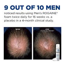 Gel hair loss is caused from the toxic ingredients listed below. Men S Rogaine 5 Minoxidil Topical Hair Loss And Regrowth Foam 3 Month Supply Neutrogena