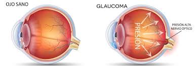 Image result for Glaucoma