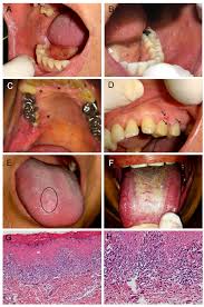 Image result for papillomavirus tongue)