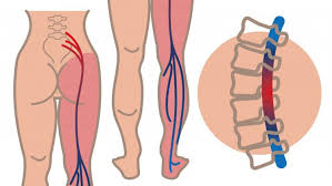 Wondering how to manage the severe sciatic nerve pain while you are pregnant? Sciatica During Pregnancy Natural Remedies For Relief