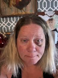 Has everyone filed a claim for PTSD due to domestic violence?