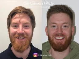 THE VB• 'Dr Dee, Here's a picture of my new smile! Thank you so much' One  of patients from Manchester who we have treated with complete replacement  dentures. That's right she has