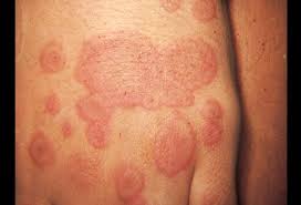 From least to most common. Lichen Planus Picture Image On Medicinenet Com