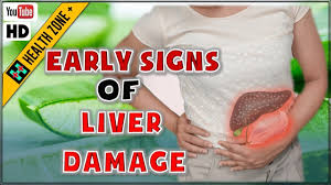 Pancreatic cancer that blocks the liver's bile duct can cause jaundice. 6 Warning Signs And Symptoms Of Pancreatic Cancer No 5 Is Shocking Youtube