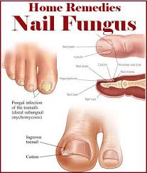 For The Highness Nail Fungus Remedy Toenail Fungus Remedies Toenail Fungus