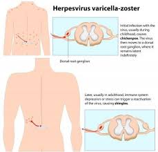Seniors And Shingles Myth Vs Fact Healthworks Collective Skin Sensitive To Touch Herpetic Neuralgia Postherpetic Neuralgia