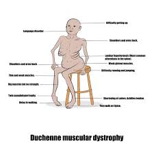 Image result for Muscular Dystrophy