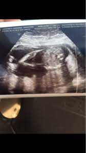 Legs Crossed At Ultrasound June 2017 Babies Forums What To Expect