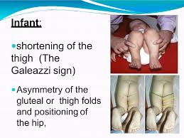 Image result for Galeazzi Sign