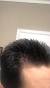 Female Hairline