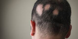 Alors localisée sur le dessus de la tête, et la ligne de cheveux du front et des tempes est préservée. Perte De Cheveux Localisee Pelade Votre Amie Essentielle