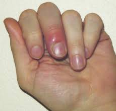 Image result for Hand Infection