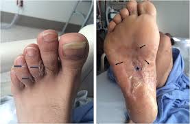 Foot reconstruction is a surgery performed to correct the anatomy of the foot and restore function lost due to trauma, birth defects, infection and other illnesses. Syphilis As Athlete S Foot The Great Imitator Strikes Again Springerlink