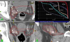 Dont go for a psa test if you dont have any symptoms of prostate cancer. Fluciclovine Pet Ct Improves Radiotherapy Targeting For Recurrent Prostate Cancer Imaging Technology News