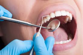 Cosmetic Bonding: Fix Chips, Gaps & Stains