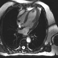 Image result for Cardiac MRI