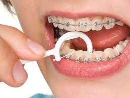 How to floss with braces. How To Properly Floss For Braces Welcome Orthodontics Blog By Dr Kyi