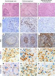 Angioimmunoblastic t cell lymphoma microenvironment. Regulatory T Cell Depletion In Angioimmunoblastic T Cell Lymphoma The American Journal Of Pathology