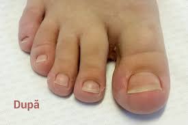 Mucus din nas care arata, de eliminarea mucusului galben sau verde in timpul unei raceli sau gripe este normal. Unghia Incarnata Remediu Si Tratament Dr Vladislav Gyebnar