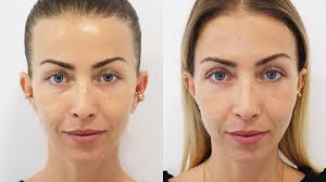 Recentemente, laura figueiredo foi convidada do podcast só mais 5 minutos, de catarina miranda, e revelou algumas curiosidades sobre a relação de longa data com o artista. Laura Figueiredo Fez Cirurgia Estetica Veja O Antes E Depois Holofote