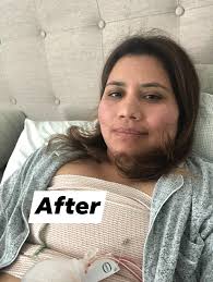 Should I opt for Exparel at explant surgery?