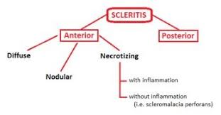 Image result for Scleritis