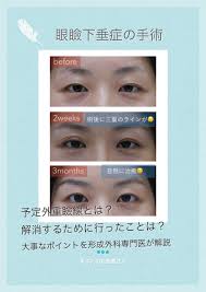 眼瞼下垂手術で予定外重瞼線 眼瞼下垂 眼瞼 手術