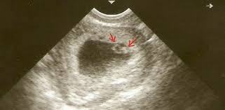 Pridajte k tomu niektoré príznaky tehotenstva a dostanete ženu, ktorá sa necíti práve dvakrát dobre. 7 Tyzden Tehotenstva Modry Konik