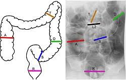Image result for Pediatric Constipation