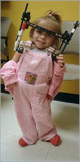 Preparing For A Halo Brace Johns Hopkins Pediatric Orthopaedics