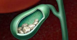 Galleblæra er et sleipt, gulgrønt og ganske ekkelt organ. Gallestein Beskrivelse Arsaker Symptomer