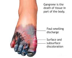 Risk factors, causes, signs and symptoms, diagnosis and treatment.what is fournier. Treatment Of Gangrene In Homeopathy Homeopathy360