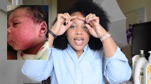 My daughter had all of the symptoms of leaky gut you mentioned, she used to throw up a lot of milk till 6 months old, she developed eczema by about 4 months, she had really bad cradle cap we couldn't get rid of, and overall was not a happy baby, cried a lot, never slept….she has tummy issues to this day, she is 3, she gets tummy aches and. Baby Eczema Update Photos Remedies Tips Youtube