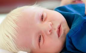 Smithkakarot 8 years ago #2. Baby Boy Born With All White Hair Stuns Doctors Page 2 Of 26 Viral Murphy