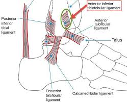 Ligaments Of An Avulsion Fracture Ankle Anatomy Ankle Ligaments Sprained Ankle
