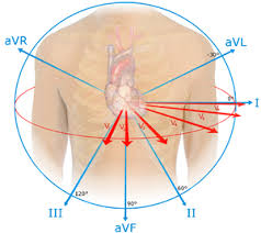 St Segment Elevation Myocardial Infarction Wikem