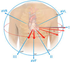 st segment elevation myocardial infarction wikem