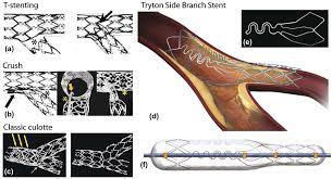 Safety and efficacy of the Tryton Side Branch Stent™ for the treatment of  coronary bifurcation lesions: an update