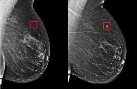 Get the knowledge you need in order to pass your classes and more. Using Ai To Predict Breast Cancer And Personalize Care Mit News Massachusetts Institute Of Technology