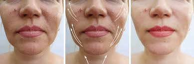 We did not find results for: Thread Lift Non Surgical Face Lift In Altrincham Cheshire Revolution Aesthetics